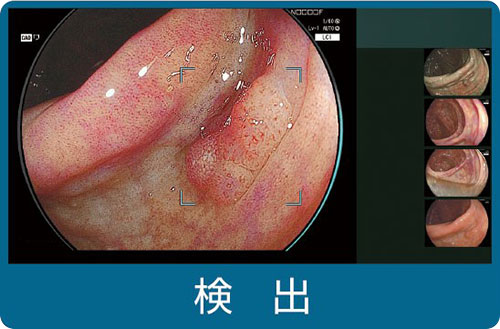 下部消化管内視鏡（大腸内視鏡）