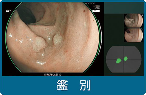 下部消化管内視鏡（大腸内視鏡）